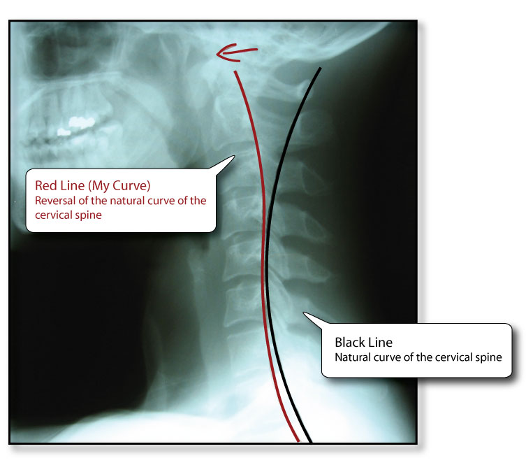 Reverse Cervical Curvature Sharis neck This is your neck on blogging