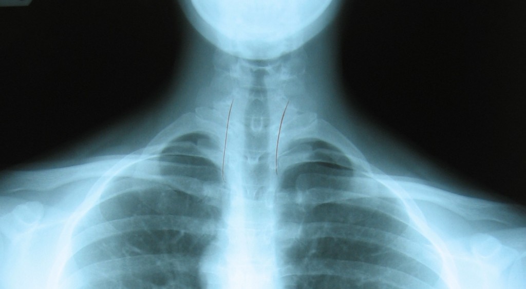 Have your posture assessed before your begin a fitness program